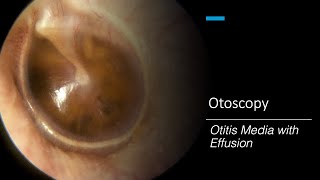 Otitis Media with Effusion Otoscopy [upl. by Itra]