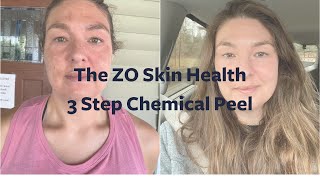 ZO® 3 Step Chemical Peel Results [upl. by Sapphire410]