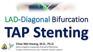 TAP Stenting of LADDiagonal Bifurcation [upl. by Ligriv960]