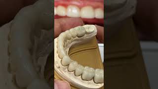 Teeth Prep and final full mouth restoration with Metal free also Metal ceramics [upl. by Dona791]