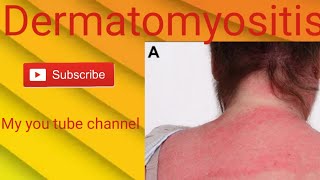 Skin disease Dermatomyositis clinical presentation [upl. by Anwahsat546]