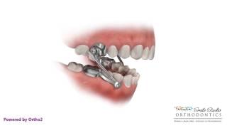 Herbst  Orthodontic Appliance [upl. by Dobbins533]