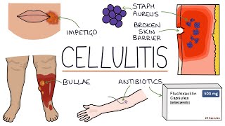 Understanding Cellulitis Skin and Soft Tissue Infections [upl. by Wilden]