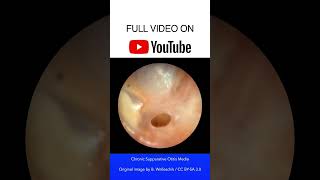 Chronic Suppurative Otitis Media Otoscopy [upl. by Xyla]