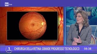 Chirurgia della retina quando e perchè [upl. by Pepe]