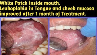 White Patch inside mouthLeukoplakia in Tongue and cheek mucosa improved after 1 month of Treatment [upl. by Atterg]