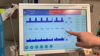 Introduction to a Drager Ventilator [upl. by Ritchie]