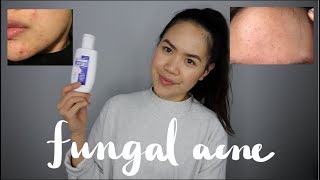 MALASSEZIA FOLLICULITISFUNGAL ACNE Tiny Forehead Bumps  My Experience and Treatment  jskavee [upl. by Ehcsrop]