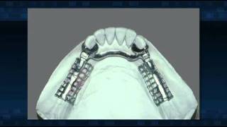 Dental Patient Education Removable Partial Dentures [upl. by Maunsell]