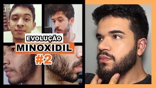 EVOLUÇÃO DE INSCRITOS  MINOXIDIL 2 [upl. by Emsoc]