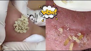 Ultimate Acne Treatment Compilation Top Tips amp Effective Solutions for Clear Skin [upl. by Adnilemreh789]