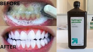 How To Get White Teeth In Just 2 Minutes With Hydrogen PeroxideWhite Teeth HACK [upl. by Kinna]