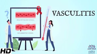 Vasculitis Everything You Need To Know [upl. by Vassaux658]