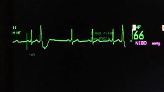 sinus rhythm with ventricular extrasystoles on an ECG heart monitor [upl. by Zorah]