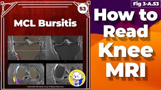 Fig 3A53 MCL Bursitis [upl. by Carbo762]