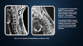 Neurology Quiz 24 TopicsMonomelic Amyotrophy Hirayama Disease Suprascapular nerve [upl. by Aicilef]