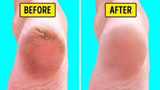 10 Natural Home Remedies for Silky Smooth Feet [upl. by Aleusnoc576]