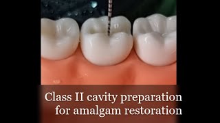 Class II Cavity Preparation for Amalgam Restoration [upl. by Imekawulo]