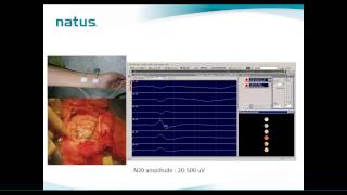 Natus IOM Webinar Brain Mapping Technique in IOM [upl. by Ebby]