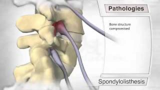 Spondylolisthesis Pathology [upl. by Hyozo]