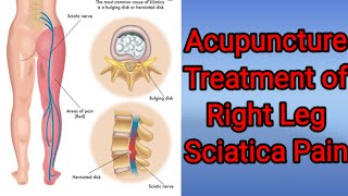 Acupuncture Treatment for Right Leg Sciatica Pain fourth Sitting Acupuncture Treatment in Hyderabad [upl. by Elwina]