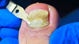 Removing Toenail Fungus FAST With These Proven Methods [upl. by Orferd]