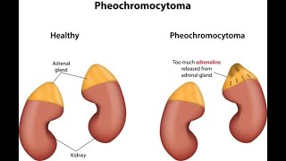 Pheochromocytoma  Simply Explained [upl. by Oisacin]