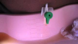 Drainage of Ascites using abdominal paracentesis [upl. by Nata]