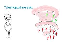 Teleskopzahnersatz  Was ist das  ein Erklärvideo [upl. by Gipsy]
