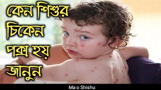 কেন শিশুর চিকেন পক্স হয় হলে করণীয়যা সবার জানা উচিত।keno shishur chicken pox hole koronio [upl. by Chud20]