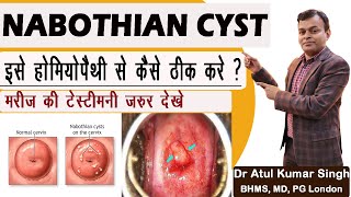 NABOTHIAN CYST  NABOTHIAN CYST KYA HOTI HAI   TREATMENT OF NABOTHIAN CYST NABOTHIAN CYST क्या है [upl. by Inahs698]