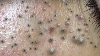 Blackheads amp Acne Treatment Latest Update with Windy Spa 2 22 [upl. by Maroj]