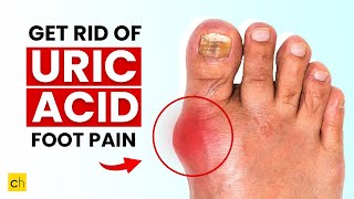 How do you get rid of URIC ACID PAIN in your foot  Must Know 7 Ways uricacid uricacid [upl. by Luella897]