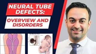 Neural Tube Defects Overview and Defects [upl. by Hsevahb]