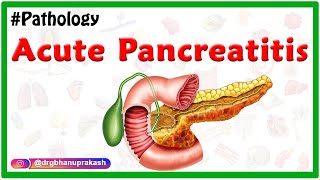 Acute Pancreatitis Etiology  signs and Symptoms pathophysiology  Diagnosis Treatment [upl. by Atcliffe121]