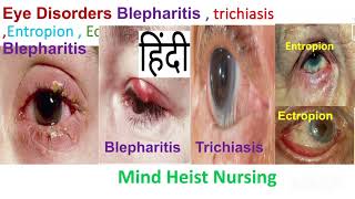 Eye DisordersBlepharitis  trichiasis Entropion  Ectropion Medical Surgical II 3rd Bsc Nursing [upl. by Oigolue]