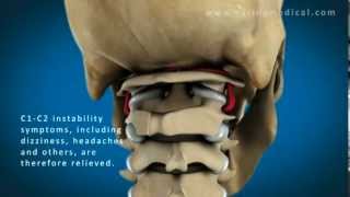 C1 and C2 Atlantoaxial Instability Upper Cervical Instability and Prolotherapy animation [upl. by Schild496]