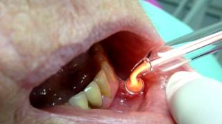 Canker Sores treatment Ozone DTA [upl. by Jeffcott373]