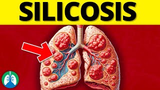 What is Silicosis EXPLAINED [upl. by Atir]