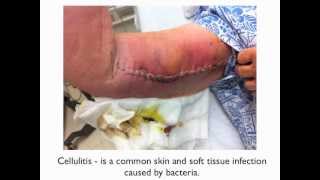 Cellulitis  a patient education video [upl. by Etteuqal]