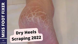 How to Treat Dry Cracked Heels 2022  Dry Heels Scraping By Miss Foot Fixer [upl. by Ioab]