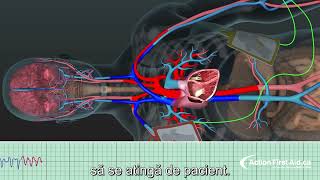 Defibrilarea  mecanismul de funcționare [upl. by Aihpos929]