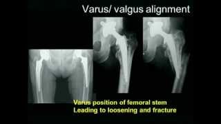 Biomechanics of the Hip Joint [upl. by Otilia326]