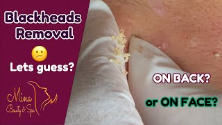 Satisfying Video Acne Blackheads Removal ON BACK or ON FACE  Mina Spa BuBuPlus Mina HIEN NGUYEN [upl. by Nahtanod]