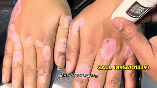 MOST FULL VITILIGO COVERAGE FOUNDATION VITILIGO SKIN PERMANENT MAKEUP  MICROSKIN  VITILIGOCURES [upl. by Serafina]