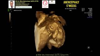 Anencephaly 17 weeks [upl. by Izogn]