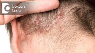 What is the management of Scalp Psoriasis  Dr Rashmi Ravindra [upl. by Hawger]