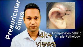 Preauricular Sinus Complexities behind Simple Pathology [upl. by Nimesh]