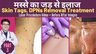 Skin Tags Removal Treatment  DPN Removal Treatment  मस्सो का इलाज  CO2 Laser treatment [upl. by Aisatal]