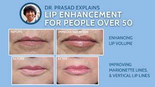 Why Lip Enhancement Over Age 50 Needs More than Lip Fillers [upl. by Ahoufe]